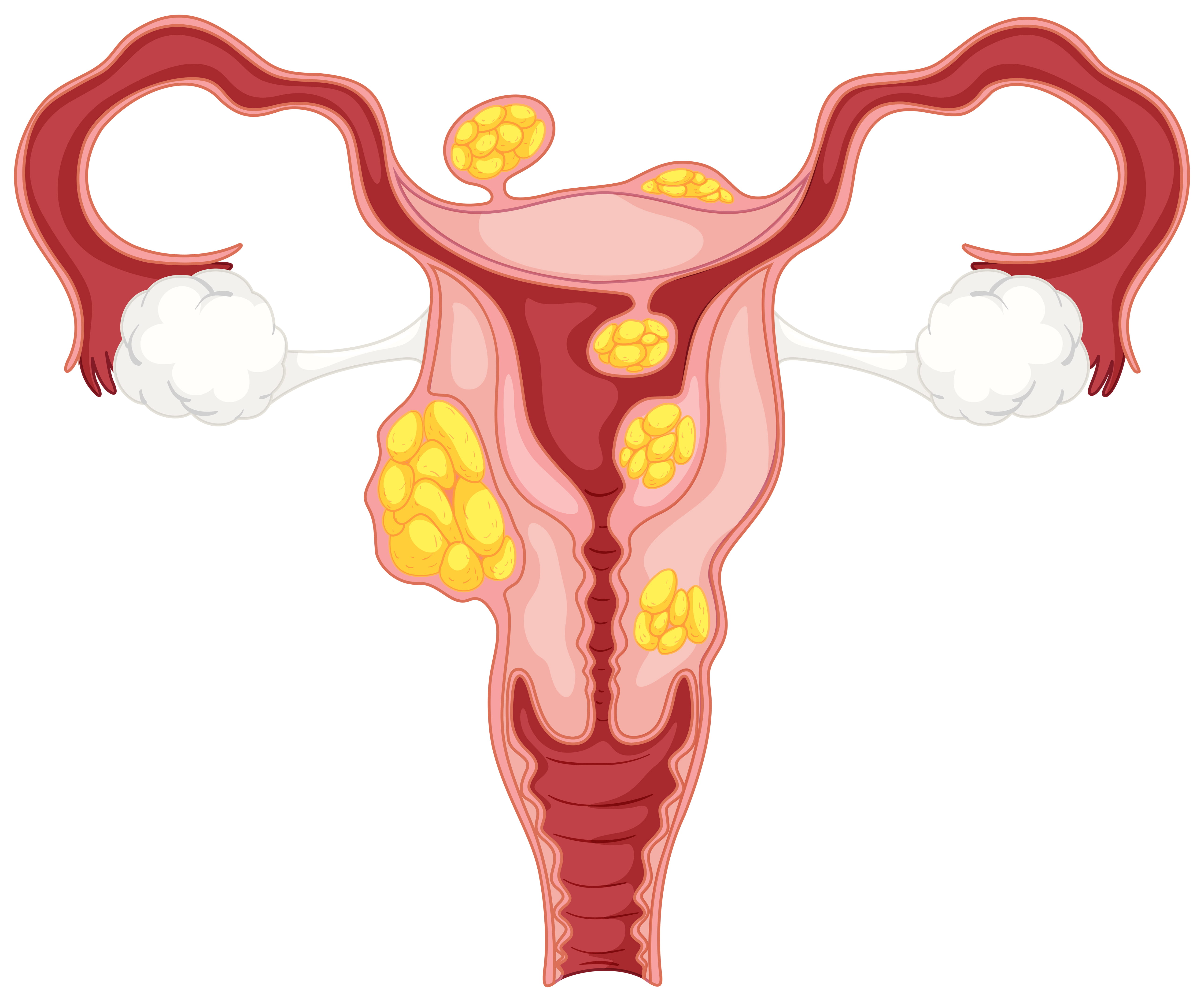 Polycystic Ovary Syndrome package